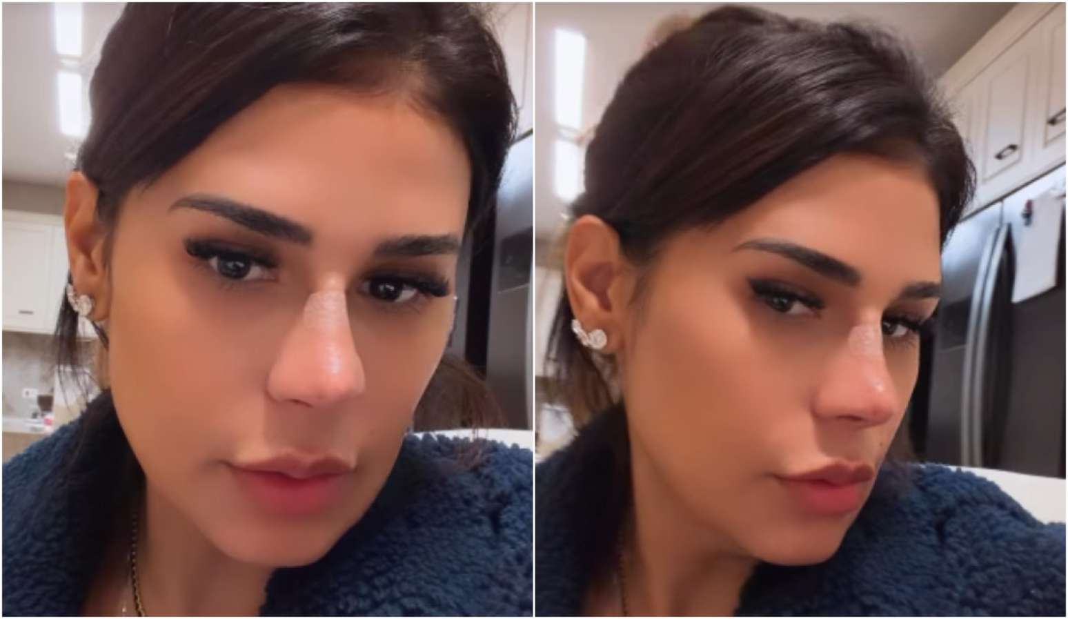 Simone Mendes mostra resultado após procedimento no nariz