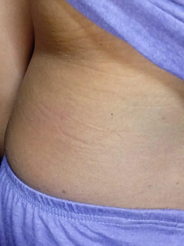 The swelling to the left side of Teral Rampartab’s back after she was allegedly hit by her teacher with a plank.